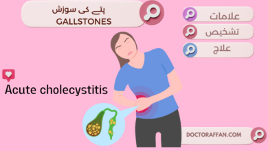 Acute cholecystitis Causes, Treatment, Diagnosis in urdu