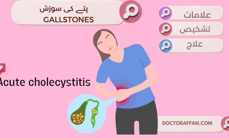 Acute cholecystitis Causes, Treatment, Diagnosis in urdu