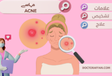 Acne causes and treatment in urdu