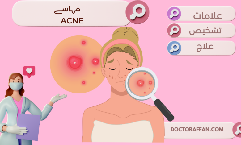 Acne causes and treatment in urdu